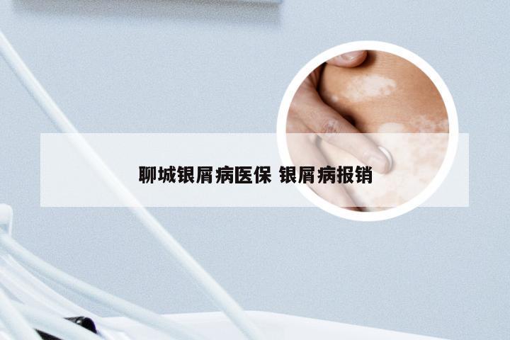 聊城银屑病医保 银屑病报销