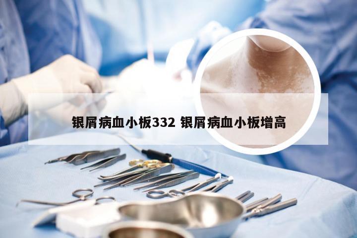 银屑病血小板332 银屑病血小板增高