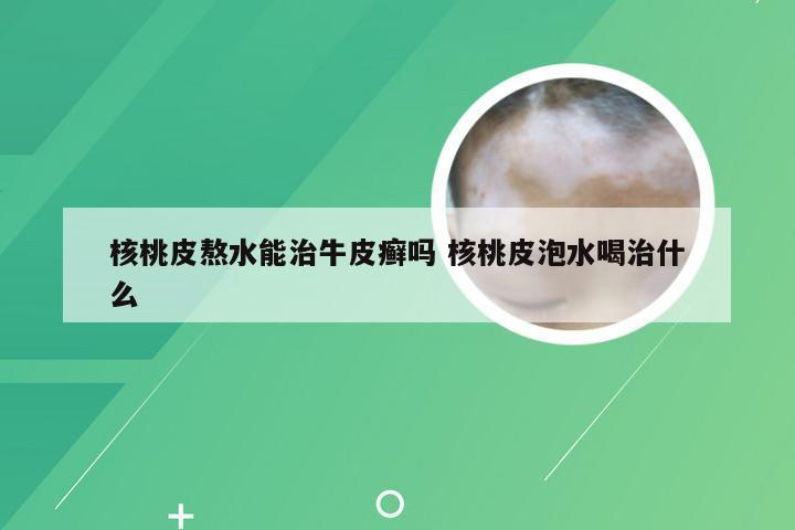 核桃皮熬水能治牛皮癣吗 核桃皮泡水喝治什么