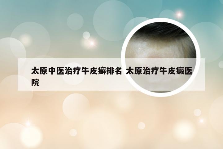 太原中医治疗牛皮癣排名 太原治疗牛皮癜医院