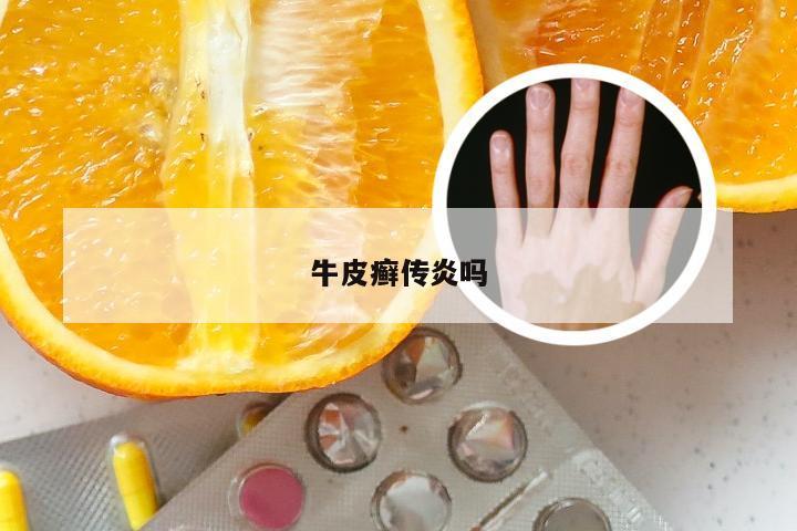 牛皮癣传炎吗