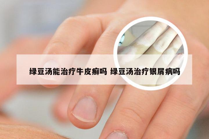 绿豆汤能治疗牛皮癣吗 绿豆汤治疗银屑病吗
