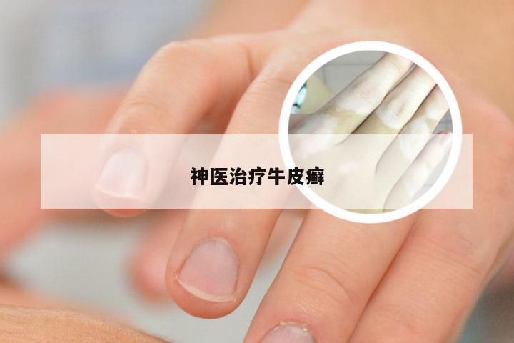 神医治疗牛皮癣