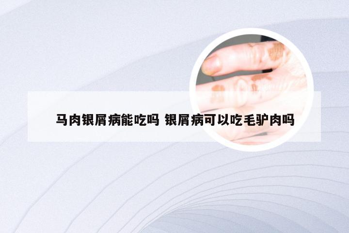 马肉银屑病能吃吗 银屑病可以吃毛驴肉吗