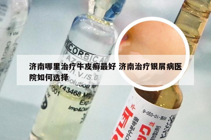 济南哪里治疗牛皮癣最好 济南治疗银屑病医院如何选择