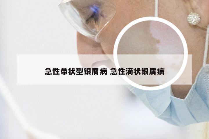 急性带状型银屑病 急性滴状银屑病