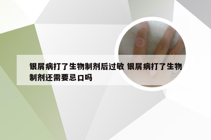 银屑病打了生物制剂后过敏 银屑病打了生物制剂还需要忌口吗