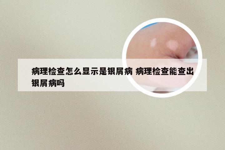 病理检查怎么显示是银屑病 病理检查能查出银屑病吗