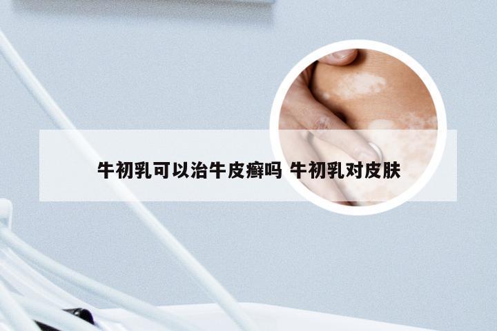 牛初乳可以治牛皮癣吗 牛初乳对皮肤