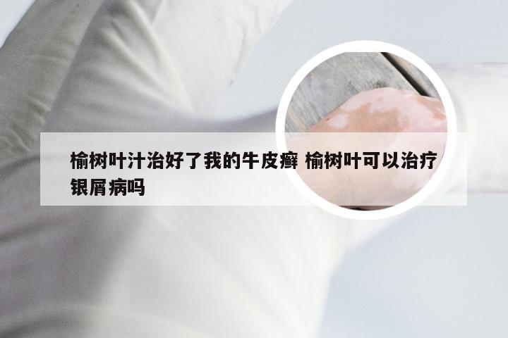 榆树叶汁治好了我的牛皮癣 榆树叶可以治疗银屑病吗