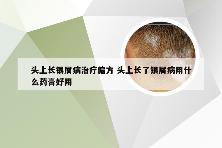 头上长银屑病治疗偏方 头上长了银屑病用什么药膏好用