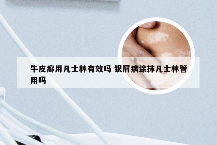 牛皮癣用凡士林有效吗 银屑病涂抹凡士林管用吗