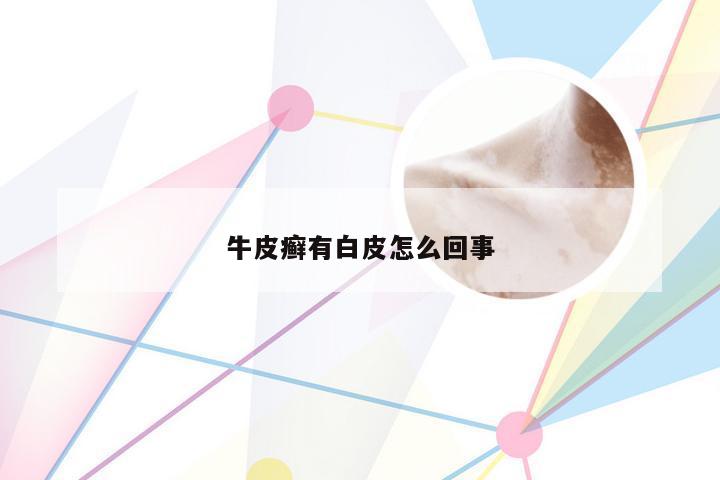 牛皮癣有白皮怎么回事