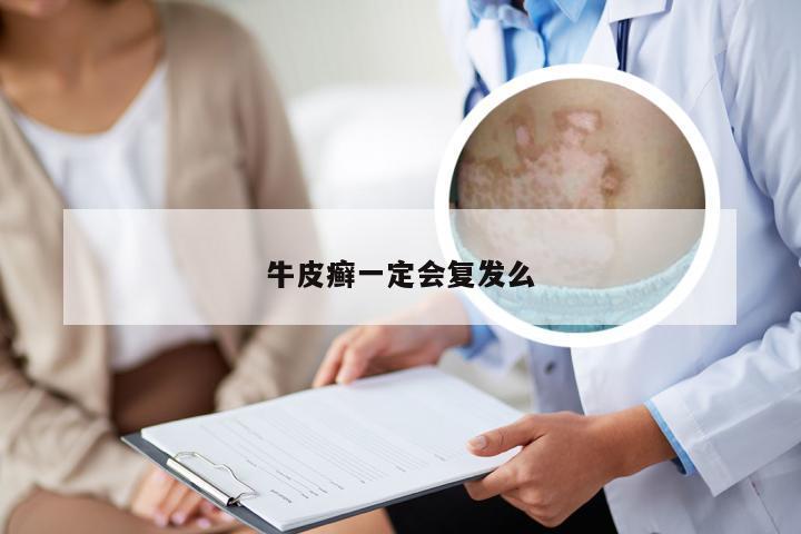 牛皮癣一定会复发么