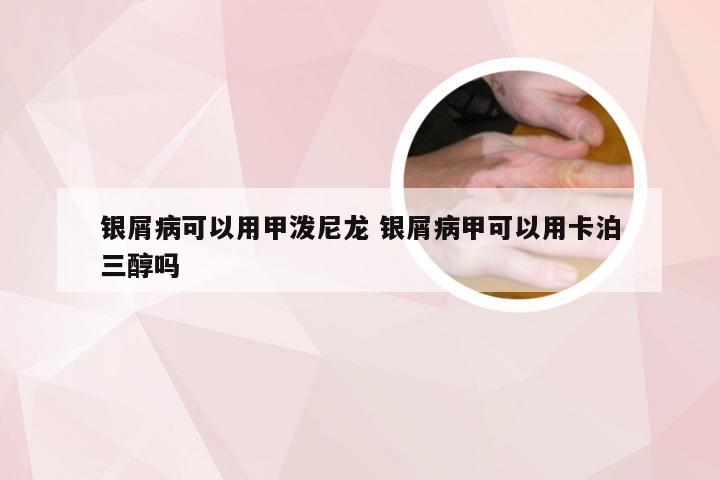 银屑病可以用甲泼尼龙 银屑病甲可以用卡泊三醇吗