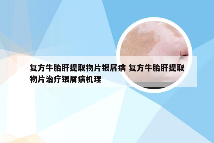 复方牛胎肝提取物片银屑病 复方牛胎肝提取物片治疗银屑病机理