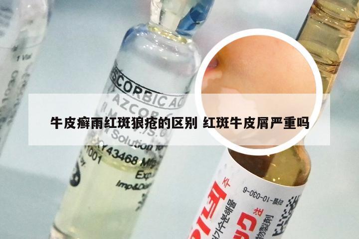 牛皮癣雨红斑狼疮的区别 红斑牛皮屑严重吗