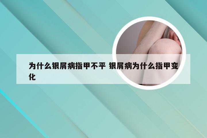 为什么银屑病指甲不平 银屑病为什么指甲变化