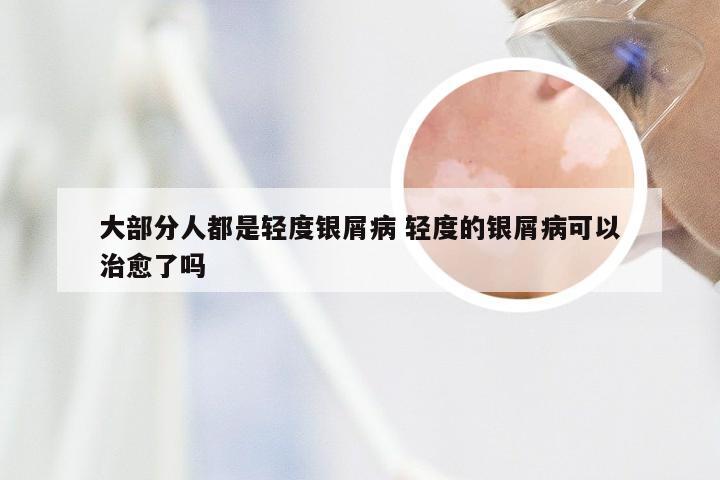 大部分人都是轻度银屑病 轻度的银屑病可以治愈了吗