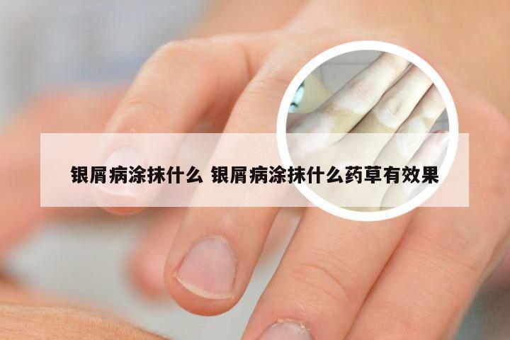 银屑病涂抹什么 银屑病涂抹什么药草有效果
