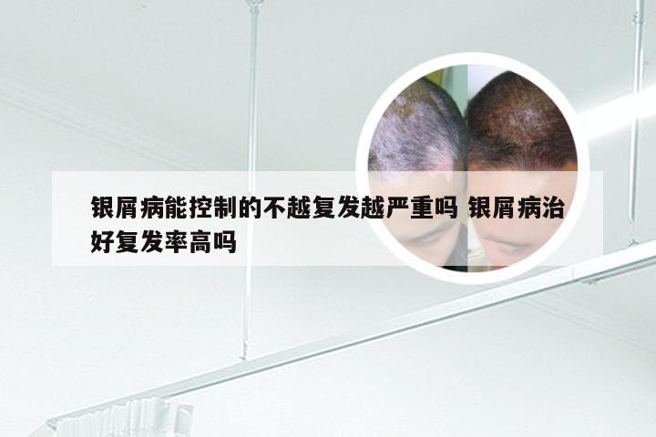 银屑病能控制的不越复发越严重吗 银屑病治好复发率高吗