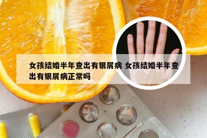 女孩结婚半年查出有银屑病 女孩结婚半年查出有银屑病正常吗