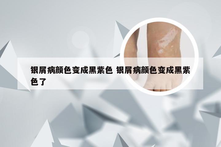 银屑病颜色变成黑紫色 银屑病颜色变成黑紫色了