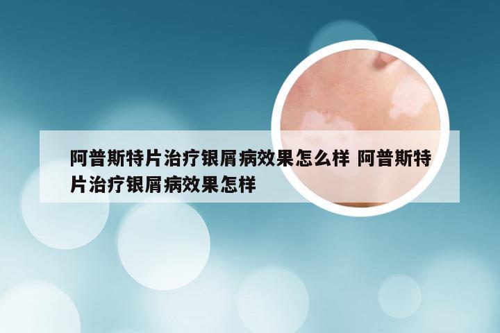 阿普斯特片治疗银屑病效果怎么样 阿普斯特片治疗银屑病效果怎样