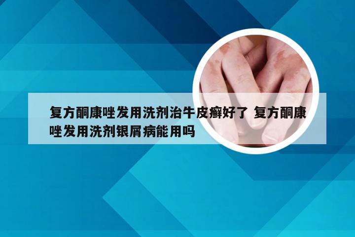 复方酮康唑发用洗剂治牛皮癣好了 复方酮康唑发用洗剂银屑病能用吗