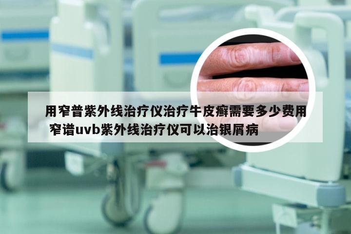 用窄普紫外线治疗仪治疗牛皮癣需要多少费用 窄谱uvb紫外线治疗仪可以治银屑病