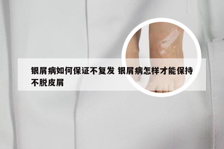 银屑病如何保证不复发 银屑病怎样才能保持不脱皮屑