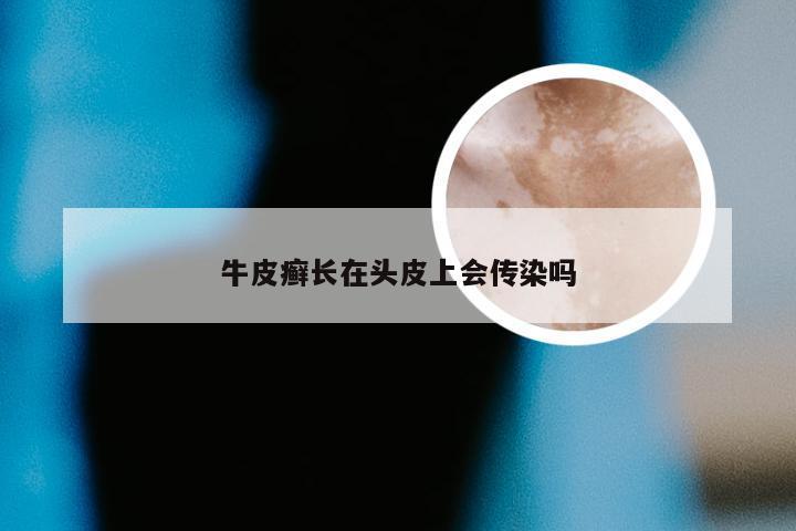 牛皮癣长在头皮上会传染吗