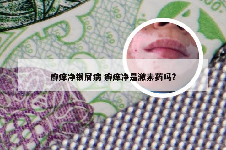 癣痒净银屑病 癣痒净是激素药吗?