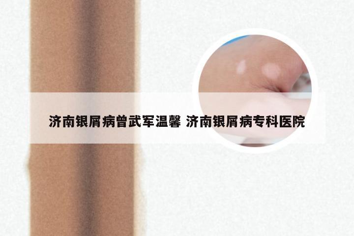 济南银屑病曾武军温馨 济南银屑病专科医院
