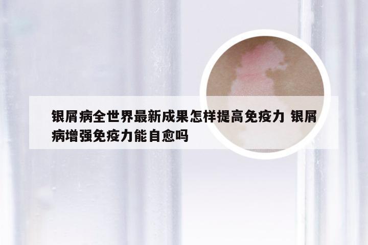 银屑病全世界最新成果怎样提高免疫力 银屑病增强免疫力能自愈吗