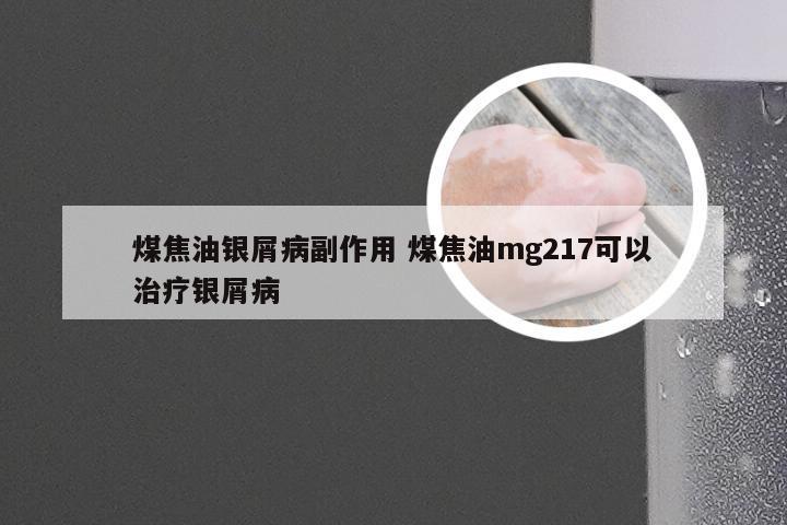 煤焦油银屑病副作用 煤焦油mg217可以治疗银屑病