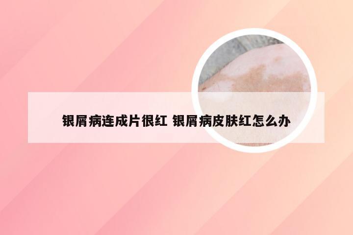 银屑病连成片很红 银屑病皮肤红怎么办