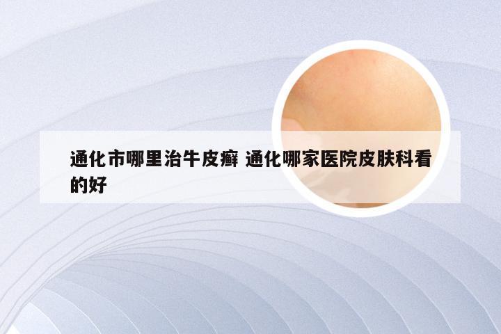 通化市哪里治牛皮癣 通化哪家医院皮肤科看的好