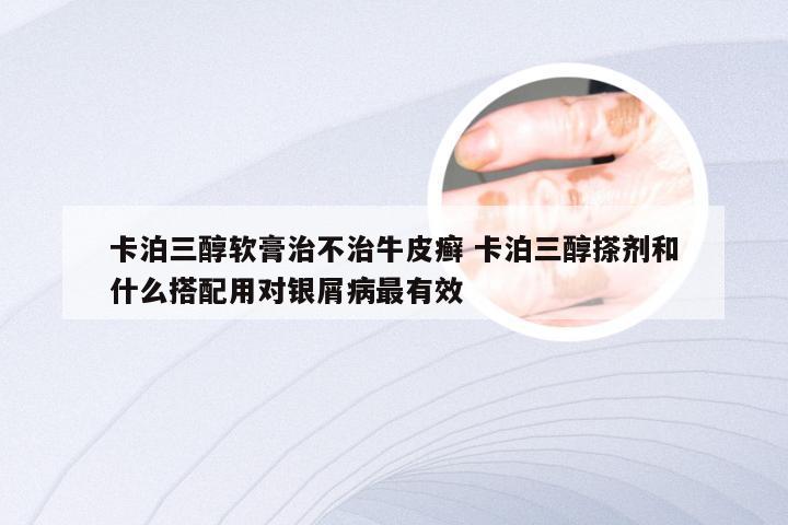 卡泊三醇软膏治不治牛皮癣 卡泊三醇搽剂和什么搭配用对银屑病最有效