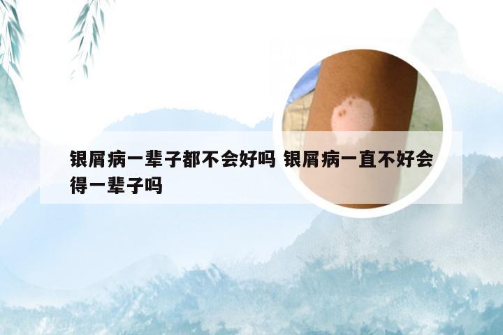 银屑病一辈子都不会好吗 银屑病一直不好会得一辈子吗