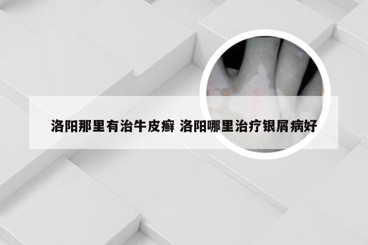 洛阳那里有治牛皮癣 洛阳哪里治疗银屑病好