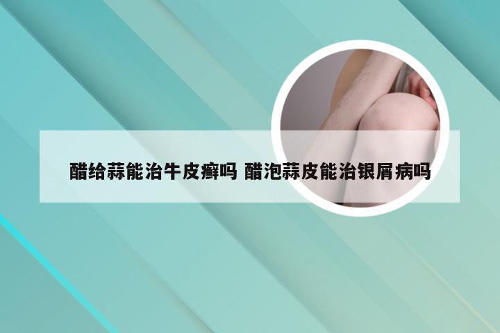 醋给蒜能治牛皮癣吗 醋泡蒜皮能治银屑病吗