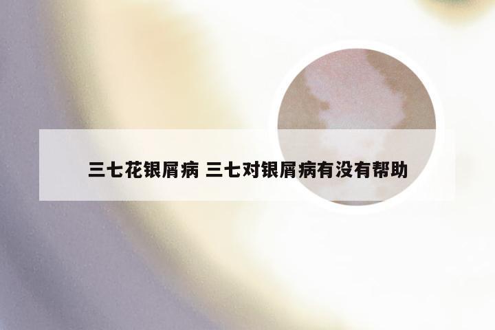 三七花银屑病 三七对银屑病有没有帮助