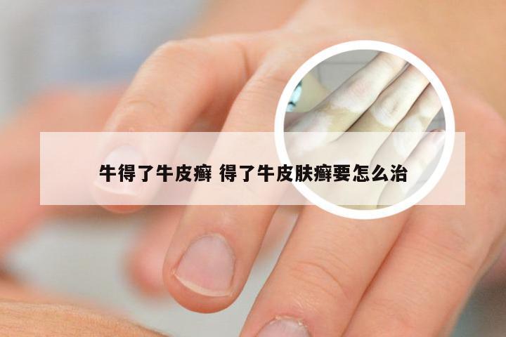 牛得了牛皮癣 得了牛皮肤癣要怎么治