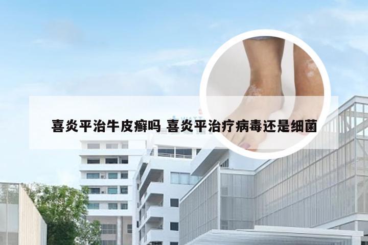 喜炎平治牛皮癣吗 喜炎平治疗病毒还是细菌