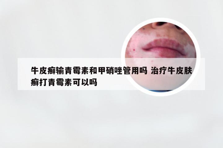 牛皮癣输青霉素和甲硝唑管用吗 治疗牛皮肤癣打青霉素可以吗