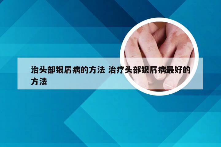 治头部银屑病的方法 治疗头部银屑病最好的方法