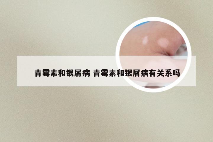 青霉素和银屑病 青霉素和银屑病有关系吗
