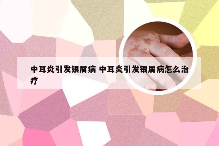 中耳炎引发银屑病 中耳炎引发银屑病怎么治疗