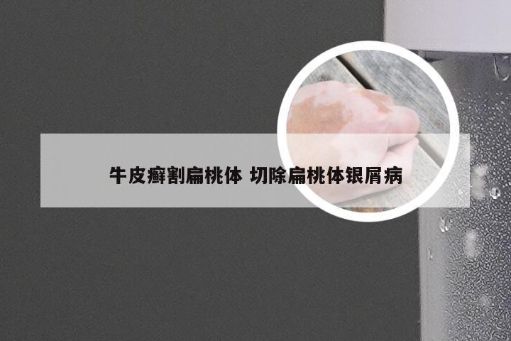 牛皮癣割扁桃体 切除扁桃体银屑病